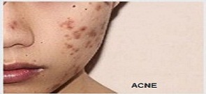 ACNE / Pimples (Facial)